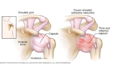 The unexpected problem with a Frozen Shoulder