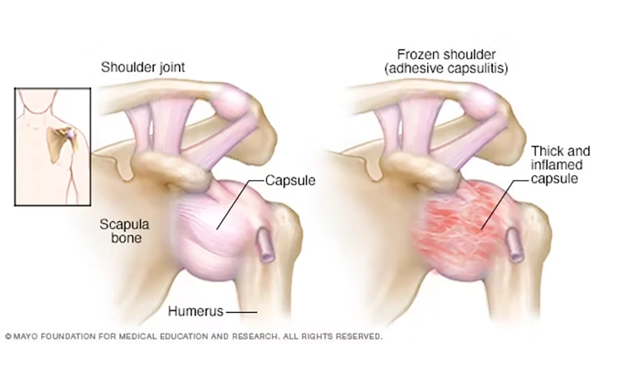 Frozen Shoulder treatment Calgary Alberta