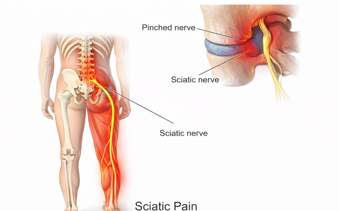 Sciatic Nerve Pain Treatment Calgary AB