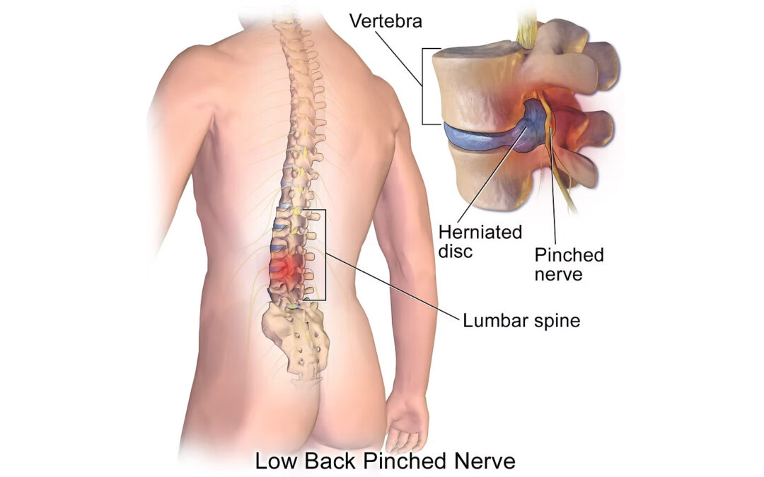 Sciatica vs Piriformis Syndrome